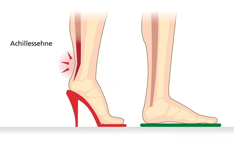 Grafische Darstellung der Achillessehne, die Belastung und Druck durch das Tragen von hohen Absätzen und flachen Schuhen zeigt.