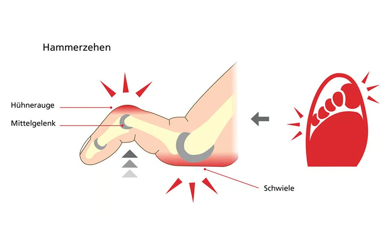 Illustration eines Hammerzehs, die ein Hühnerauge, Mittelgelenk und eine Schwiele zeigt